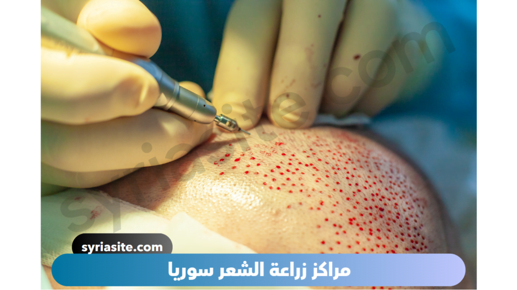 مراكز زراعة الشعر في سوريا
