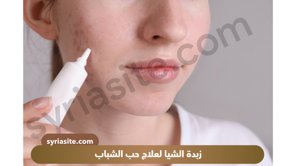 زبدة الشيا لعلاج حب الشباب