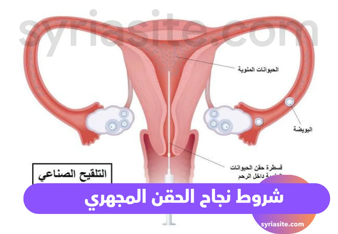 شروط نجاح الحقن المجهري