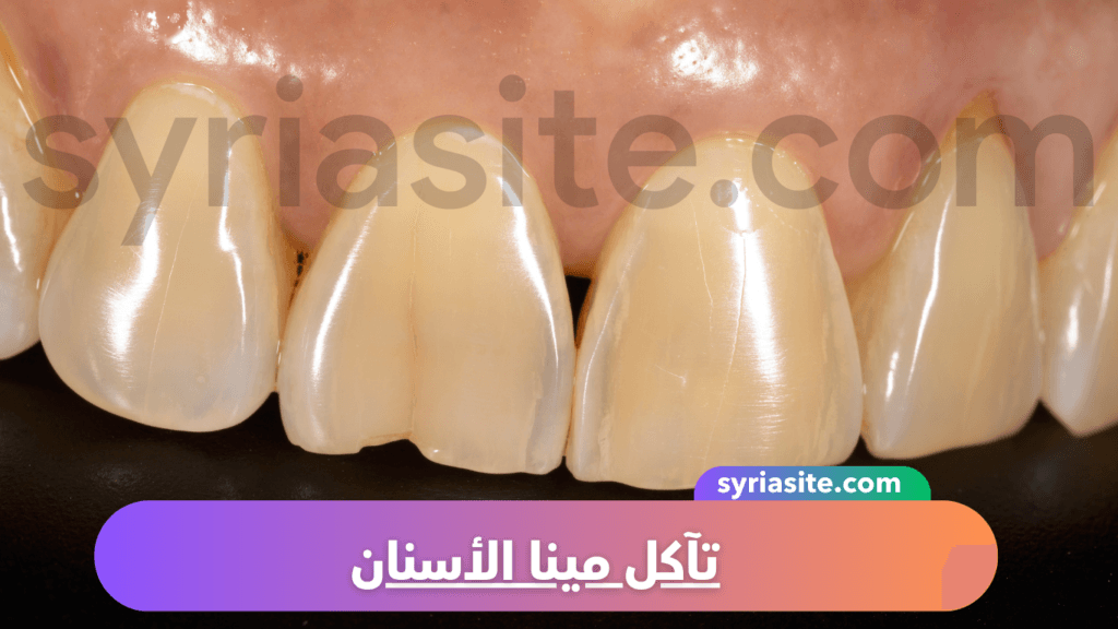تآكل مينا الأسنان