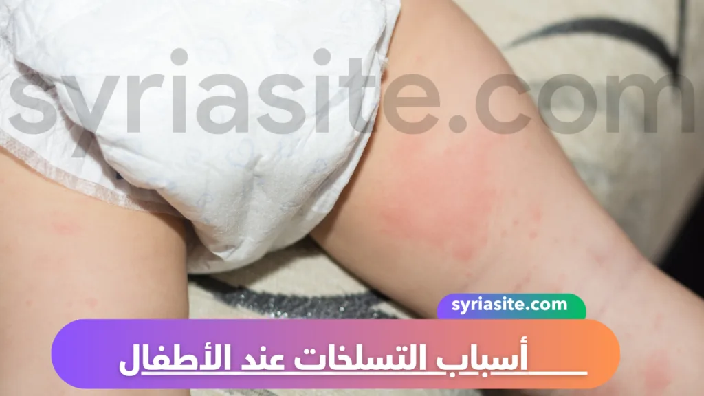 أسباب التسلخات عند الأطفال
