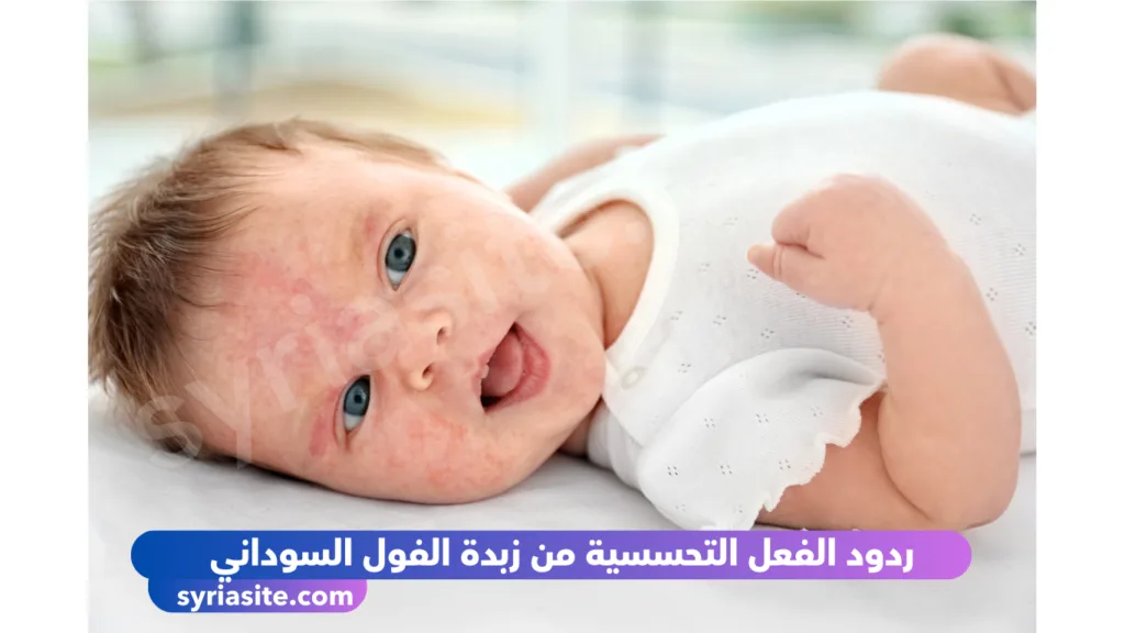 ردود الفعل التحسسية من زبدة الفول السوداني