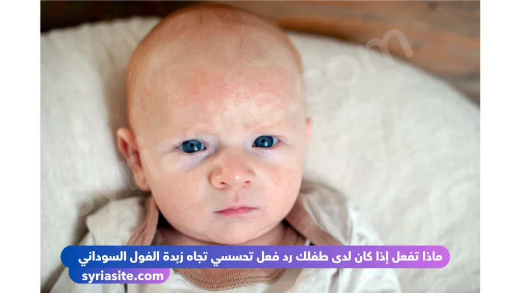 ماذا تفعل إذا كان لدى طفلك رد فعل تحسسي تجاه زبدة الفول السوداني