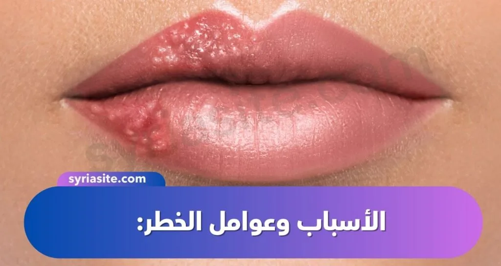 حبوب الحمى في الشفاه: دليل شامل عن الهربس الشفوي.