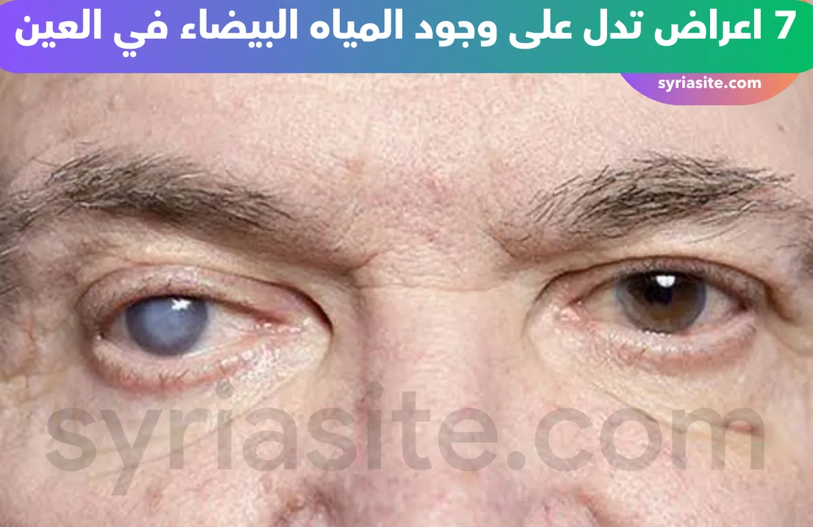 اعراض المياه البيضاء في العين