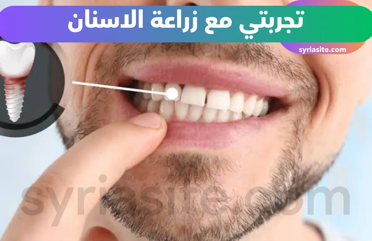 تجربتي مع زراعة الاسنان