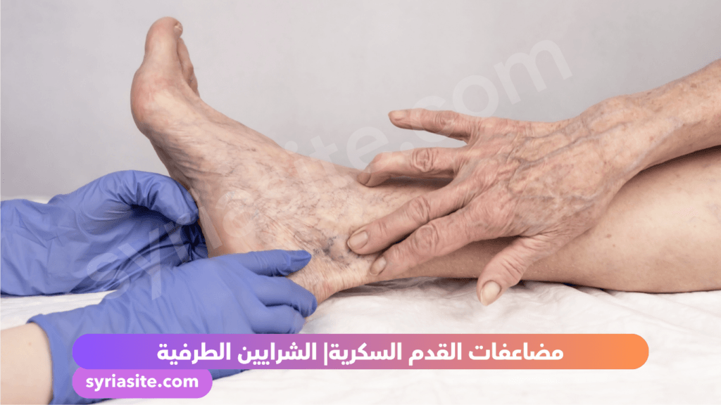 مرض السرايين الطرفية