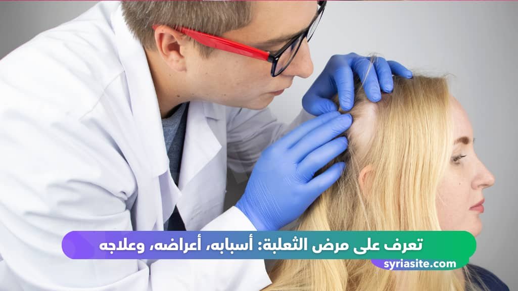 تعرف على مرض الثعلبة: أسبابه، أعراضه، وعلاجه