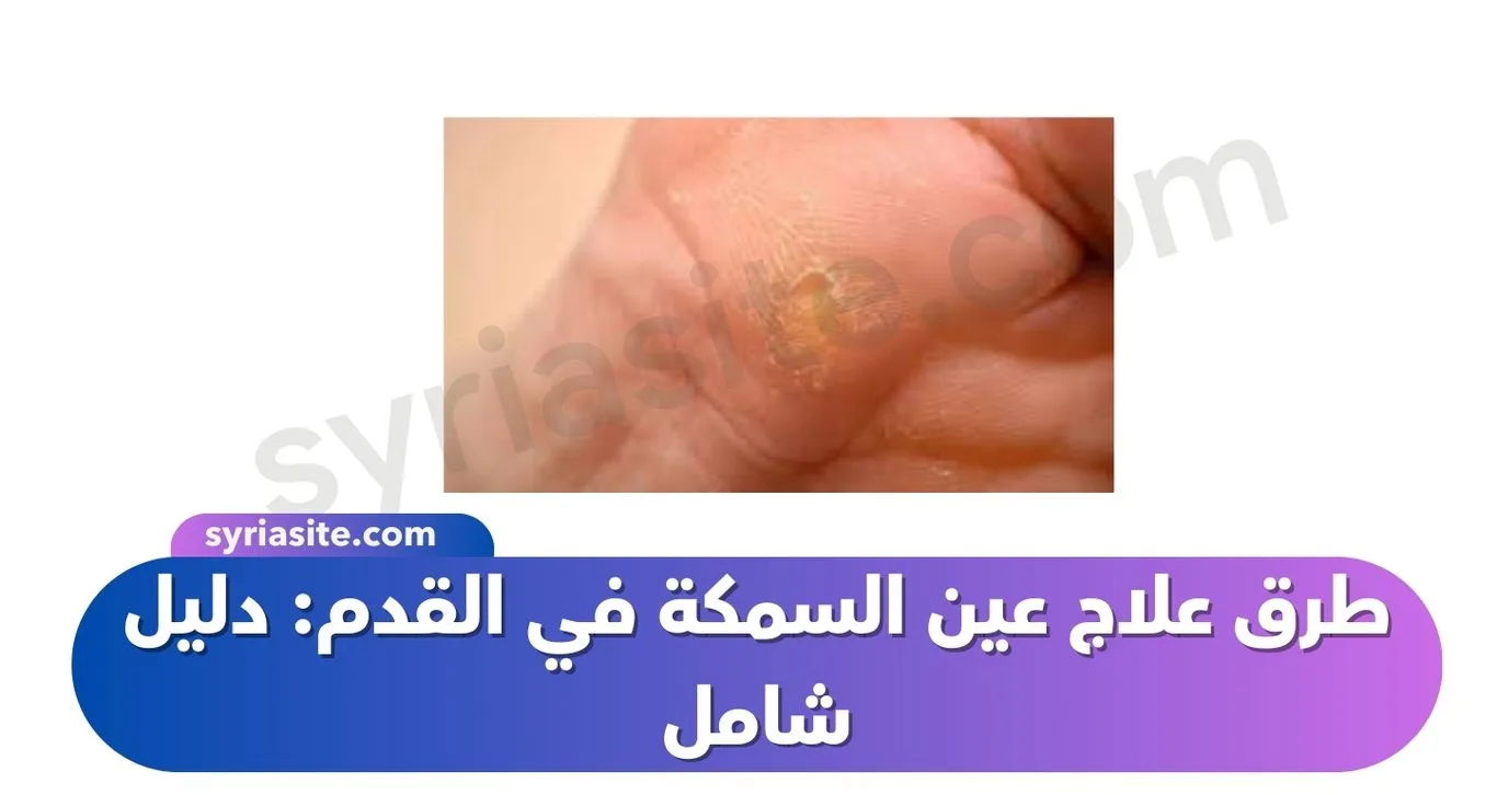طرق علاج عين السمكة في القدم: دليل شامل