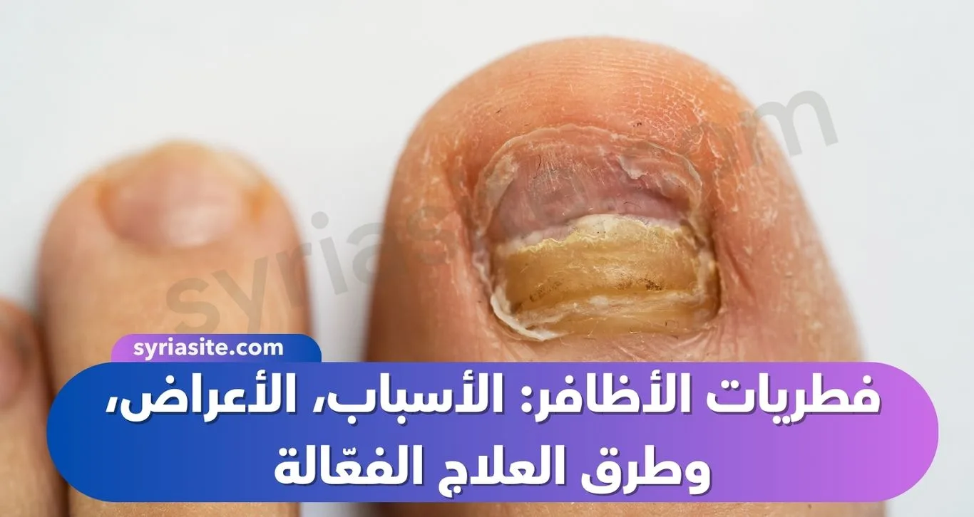 فطريات الأظافر: الأسباب، الأعراض، وطرق العلاج الفعّالة