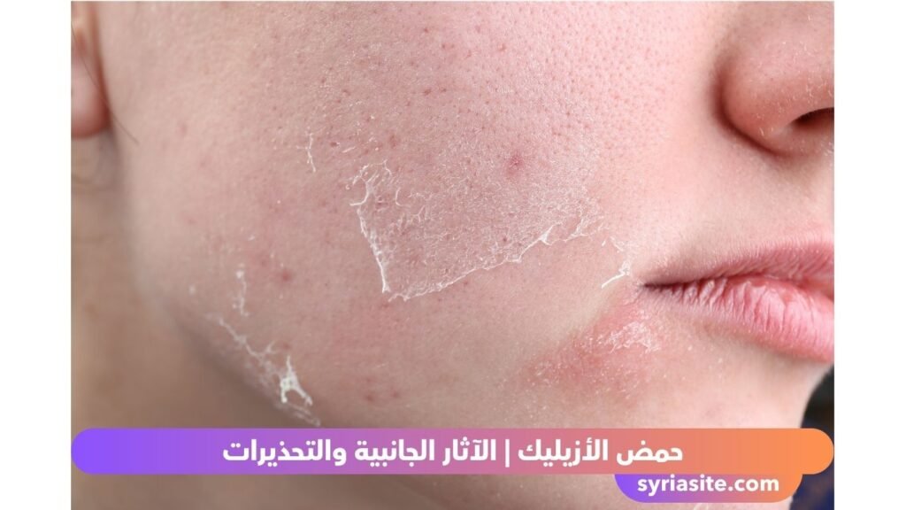 حمض الأزيليك