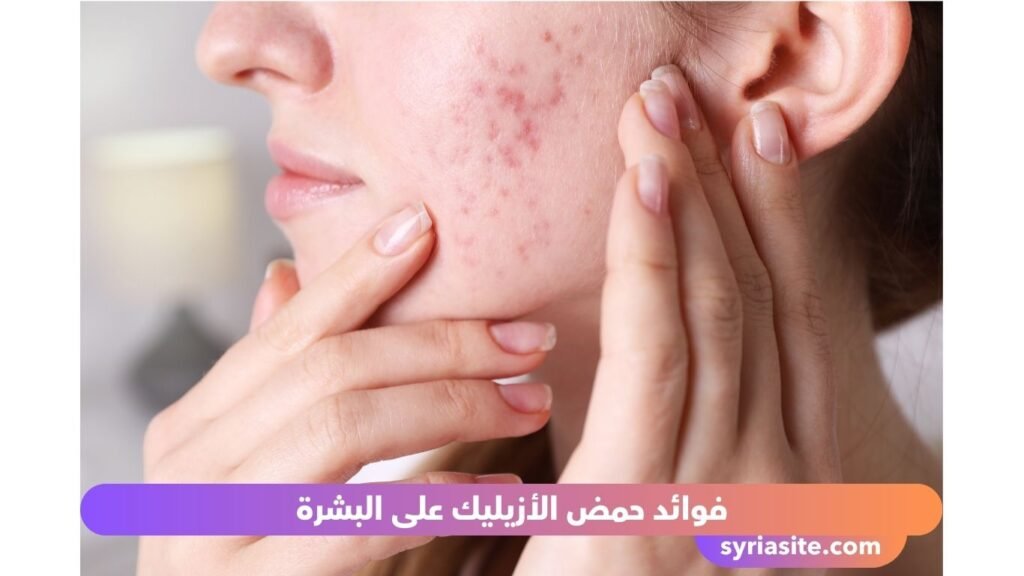 حمض الأزيليك