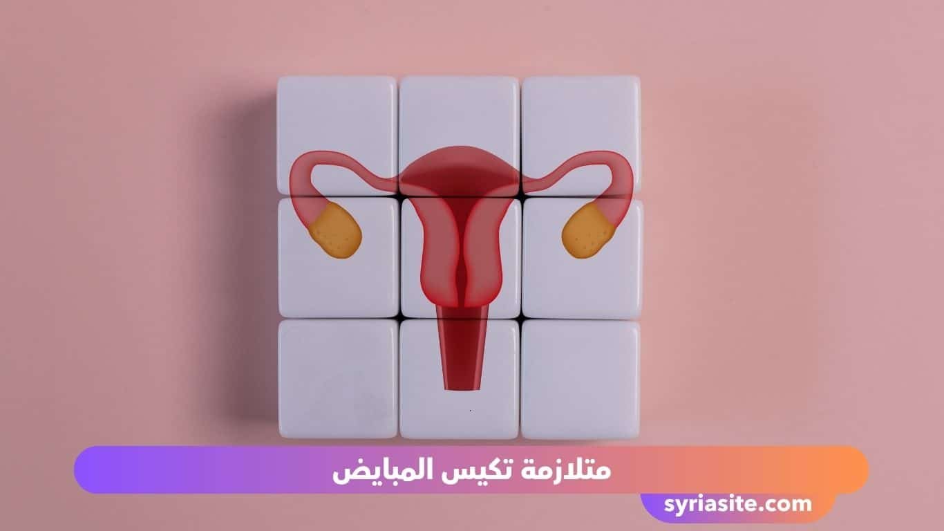 متلازمة تكيس المبايض