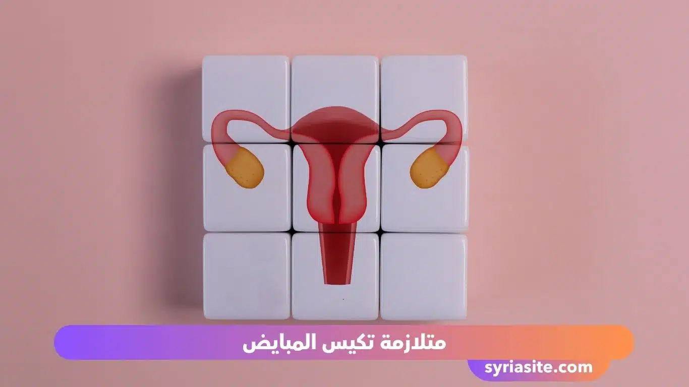 متلازمة تكيس المبايض