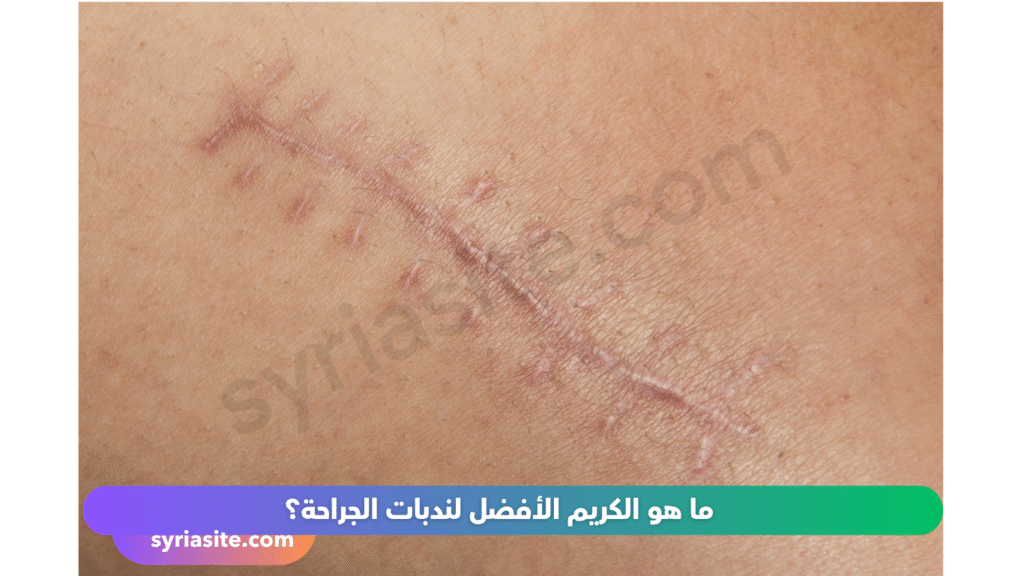كريمات علاج النديات