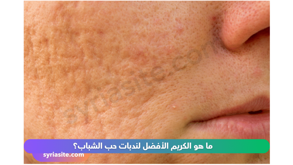 كريمات علاج النديات