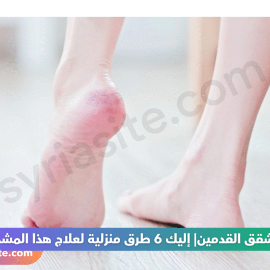 تشقق القدمين