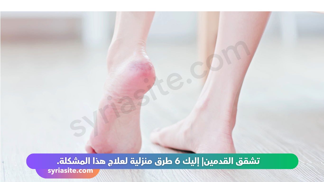 تشقق القدمين