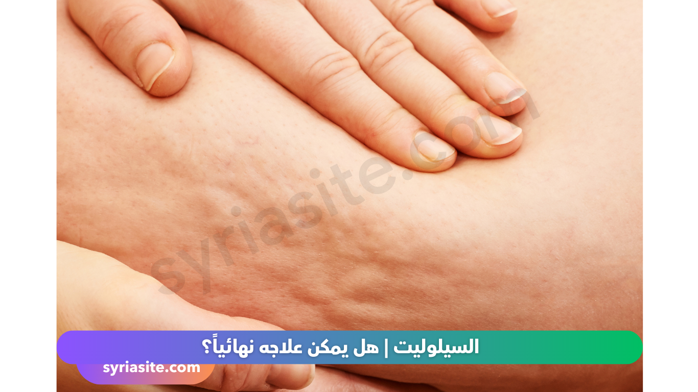 السيلوليت