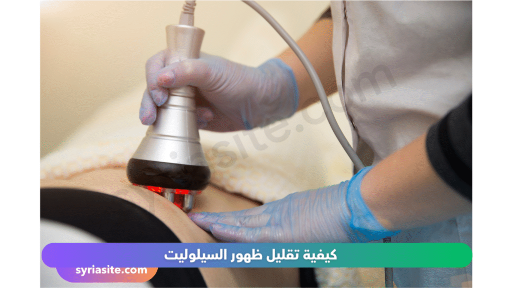 السيلوليت