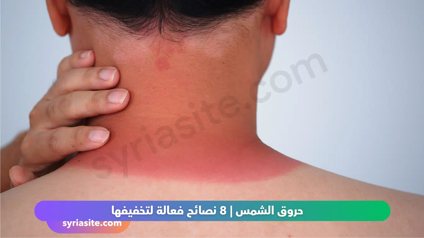 حروق الشمس