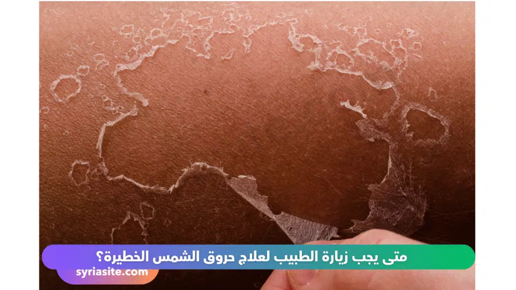 حروق الشمس